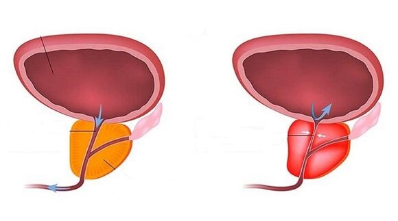 Healthy and inflamed prostatitis