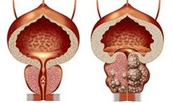 Healthy and unhealthy prostate